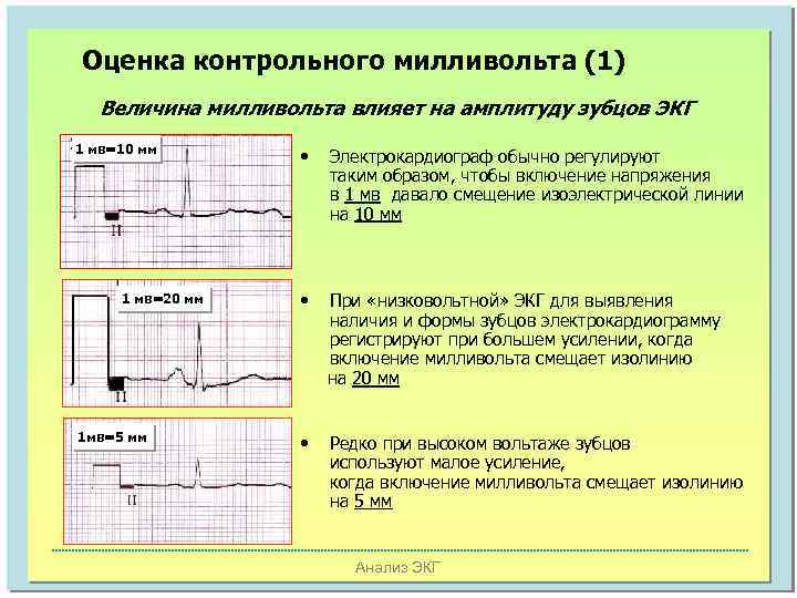 Оценка контрольного милливольта (1) Величина милливольта влияет на амплитуду зубцов ЭКГ 1 мв=10 мм