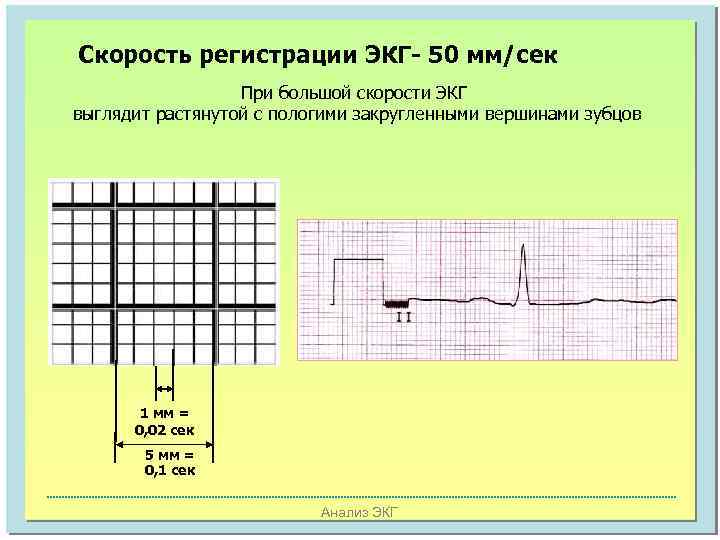 Скорость регистрации ЭКГ- 50 мм/сек При большой скорости ЭКГ выглядит растянутой с пологими закругленными