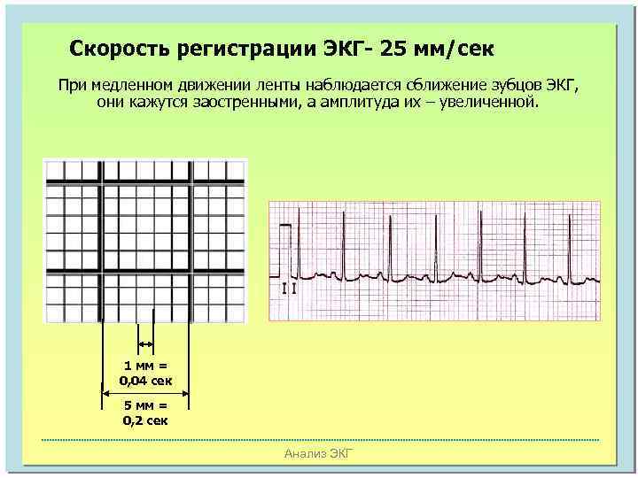 Скорость регистрации ЭКГ- 25 мм/сек При медленном движении ленты наблюдается сближение зубцов ЭКГ, они
