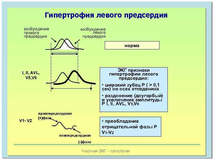 Гипертрофия левого предсердия возбуждение правого предсердия возбуждение левого предсердия норма ЭКГ признаки гипертрофии левого