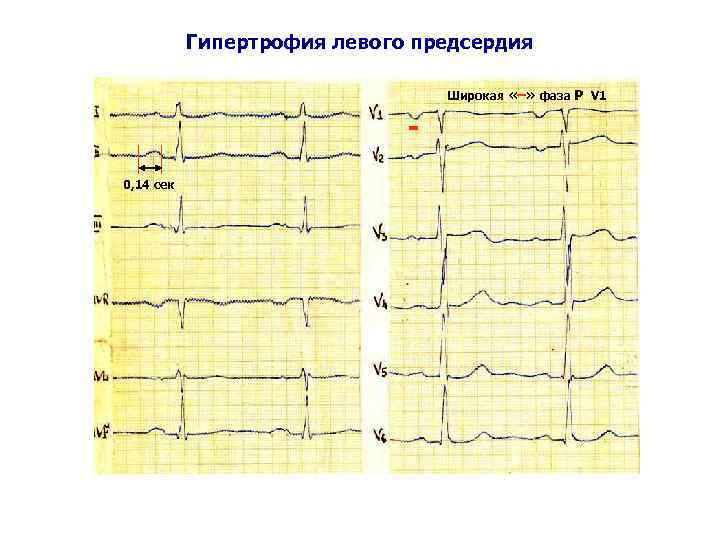 Гипертрофия левого предсердия Широкая «–» фаза Р V 1 0, 14 сек 