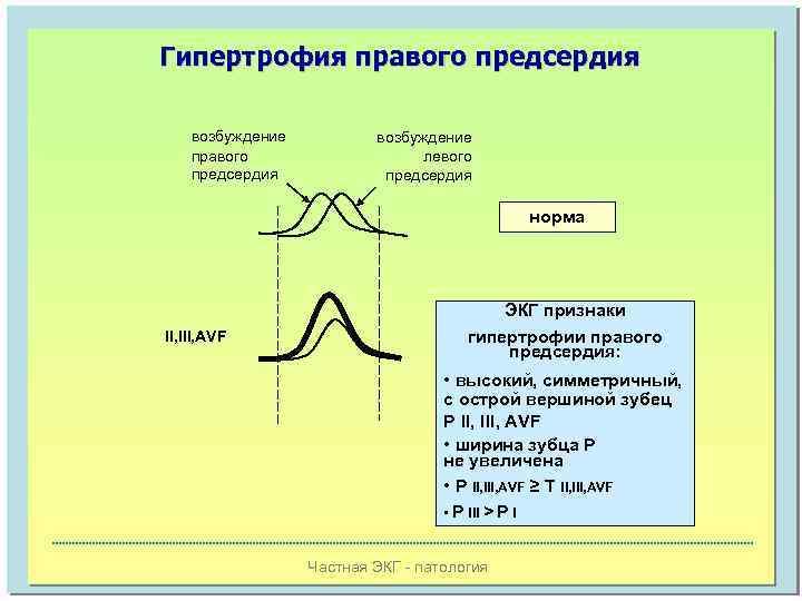 Гипертрофия правого предсердия возбуждение левого предсердия норма II, III, AVF ЭКГ признаки гипертрофии правого
