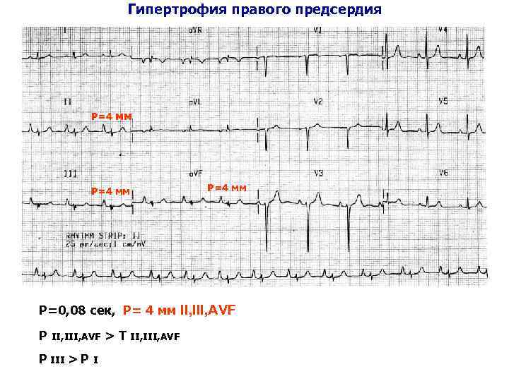 Гипертрофия правого предсердия Р=4 мм Р=0, 08 сек, Р= 4 мм II, III, AVF