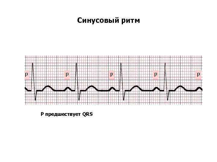 Синусовый ритм Р предшествует QRS 