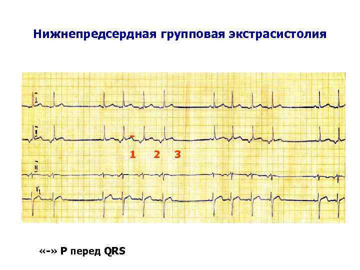 Нижнепредсердная групповая экстрасистолия 1 «-» Р перед QRS 2 3 