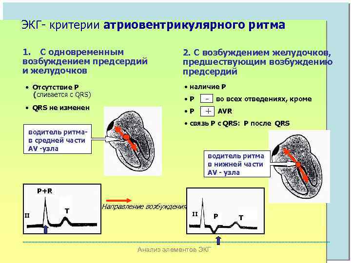 ЭКГ- критерии атриовентрикулярного ритма 1. С одновременным возбуждением предсердий и желудочков 2. С возбуждением