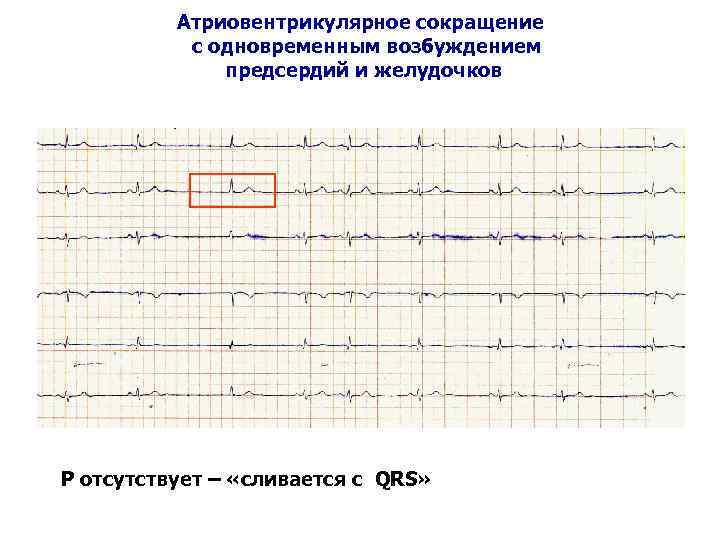 Атриовентрикулярное сокращение с одновременным возбуждением предсердий и желудочков Р отсутствует – «сливается с QRS»