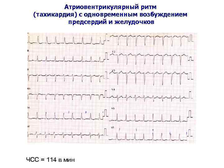Атриовентрикулярный ритм (тахикардия) с одновременным возбуждением предсердий и желудочков ЧСС = 114 в мин