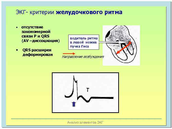 ЭКГ- критерии желудочкового ритма • • отсутствие закономерной связи Р и QRS (AV –диссоциация)