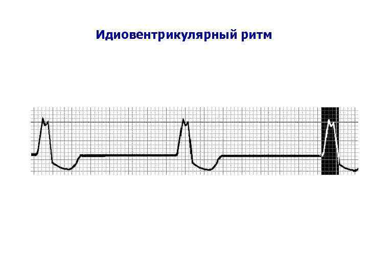 Идиовентрикулярный ритм 