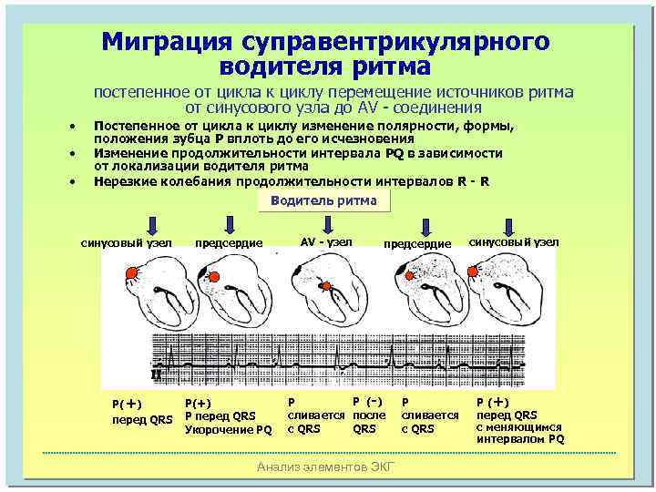Миграция суправентрикулярного водителя ритма постепенное от цикла к циклу перемещение источников ритма от синусового
