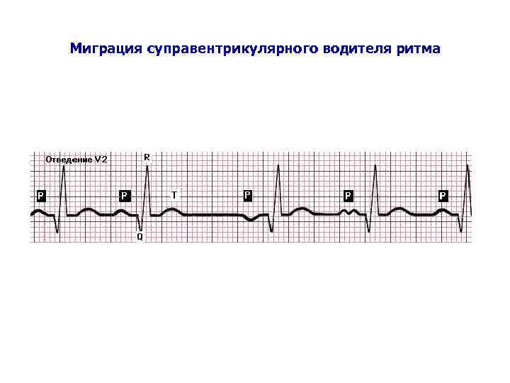 Миграция суправентрикулярного водителя ритма 