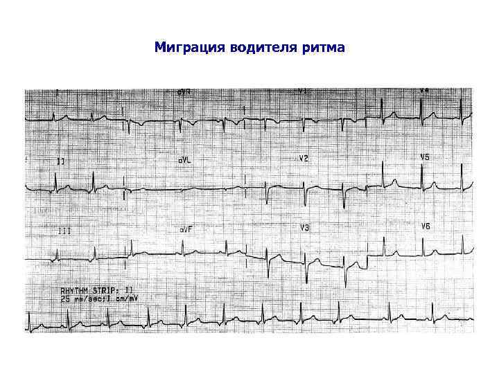 Миграция водителя ритма 