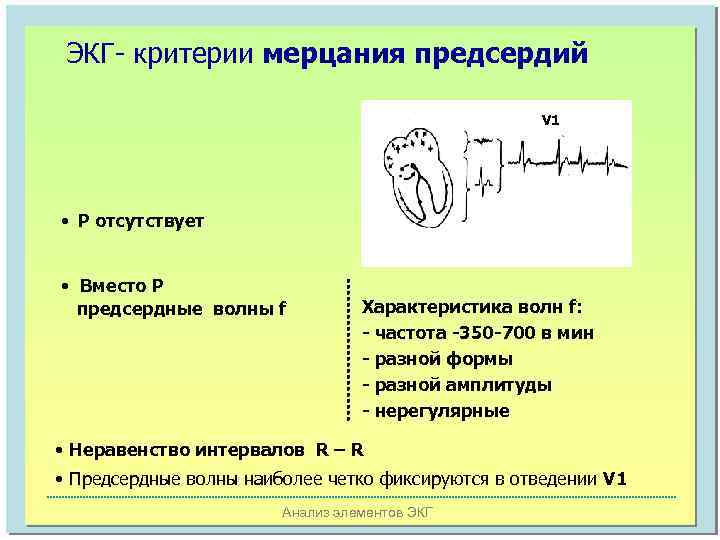 ЭКГ- критерии мерцания предсердий V 1 • Р отсутствует • Вместо Р предсердные волны