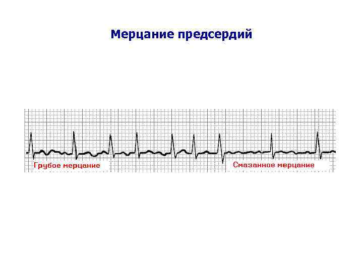 Мерцание предсердий 