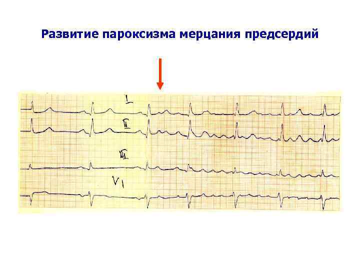 Развитие пароксизма мерцания предсердий 