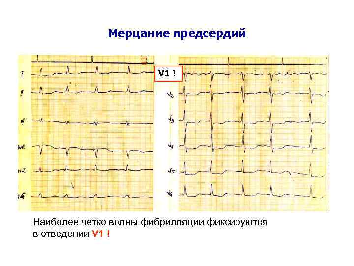Мерцание предсердий V 1 ! Наиболее четко волны фибрилляции фиксируются в отведении V 1