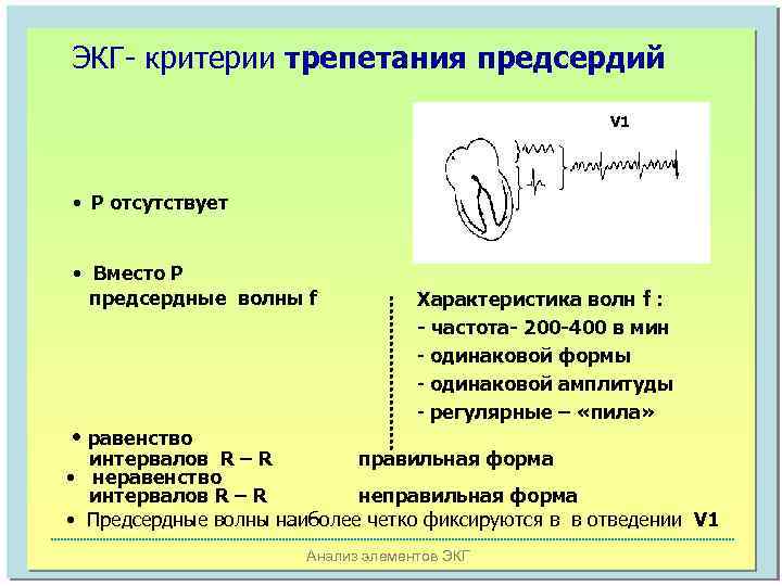 ЭКГ- критерии трепетания предсердий V 1 • Р отсутствует • Вместо Р предсердные волны
