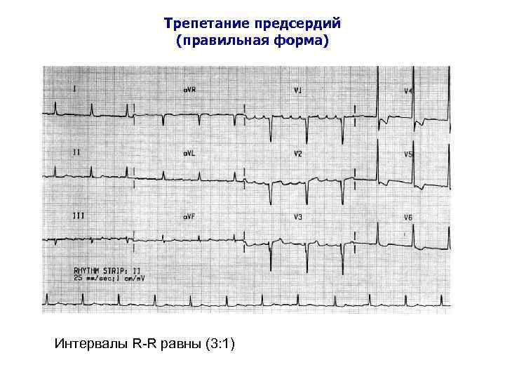 Трепетание предсердий (правильная форма) Интервалы R-R равны (3: 1) 