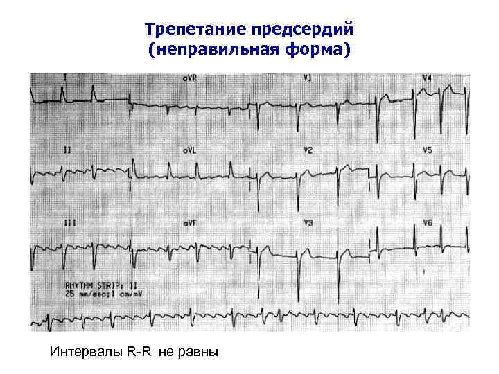 Трепетание предсердий (неправильная форма) Интервалы R-R не равны 
