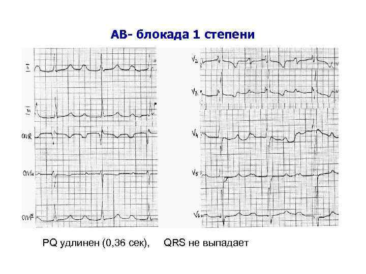 АВ- блокада 1 степени PQ удлинен (0, 36 сек), QRS не выпадает 