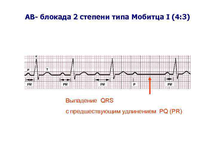 AВ- блокада 2 степени типа Мобитца I (4: 3) Выпадение QRS c предшествующим удлинением
