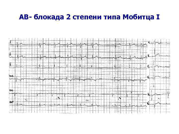 AВ- блокада 2 степени типа Мобитца I 