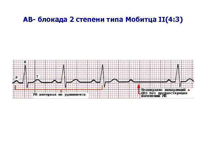 AВ- блокада 2 степени типа Мобитца II(4: 3) 