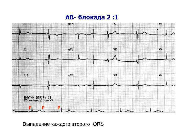 АВ- блокада 2 : 1 Р Р Р Выпадение каждого второго QRS 