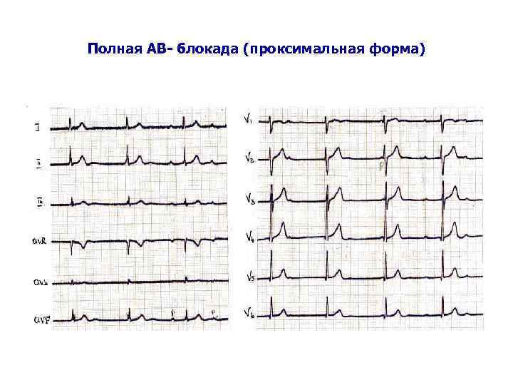 Полная АВ- блокада (проксимальная форма) 