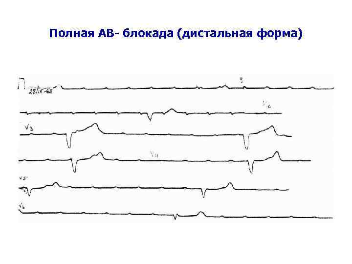 Полная АВ- блокада (дистальная форма) 