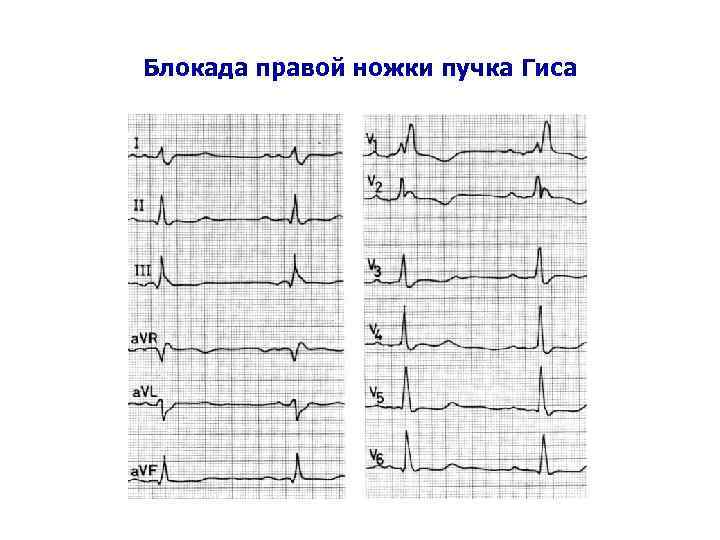 Блокада правой ножки пучка Гиса 