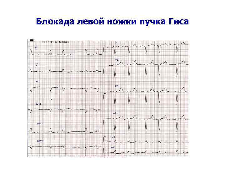 Полная блокада правого пучка гиса