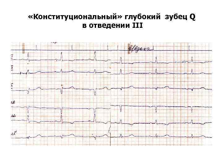  «Конституциональный» глубокий зубец Q в отведении III 