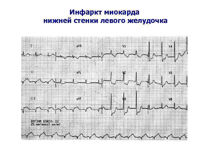 Инфаркт миокарда нижней стенки левого желудочка 