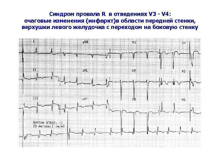 Синдром провала R в отведениях V 3 - V 4: очаговые изменения (инфаркт)в области