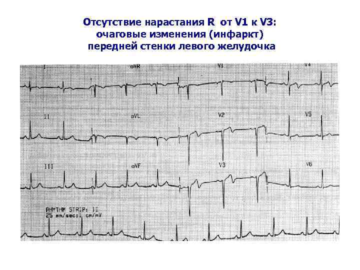 Отсутствие нарастания R от V 1 к V 3: очаговые изменения (инфаркт) передней стенки