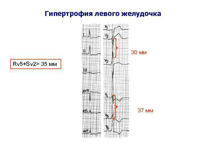 Гипертрофия левого желудочка 30 мм Rv 5+Sv 2> 35 мм 37 мм 