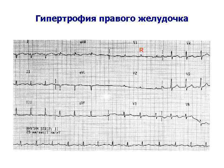 Гипертрофия правого желудочка R 