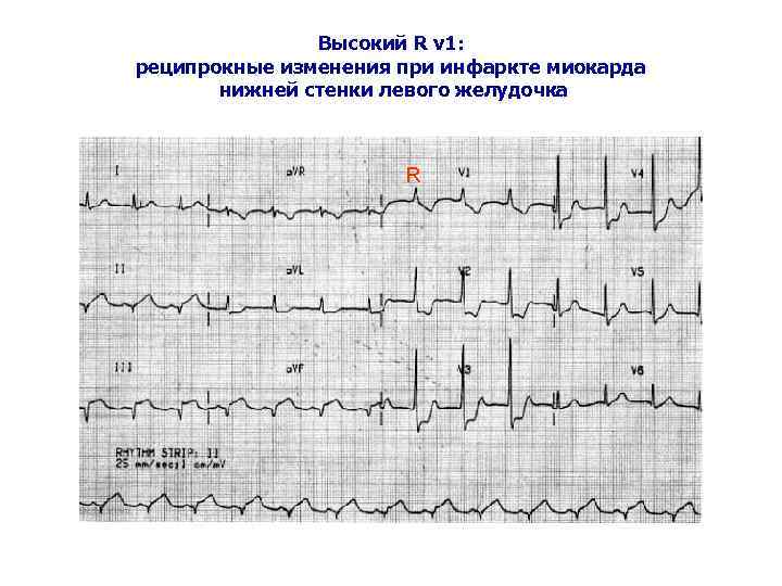 Высокий R v 1: реципрокные изменения при инфаркте миокарда нижней стенки левого желудочка R