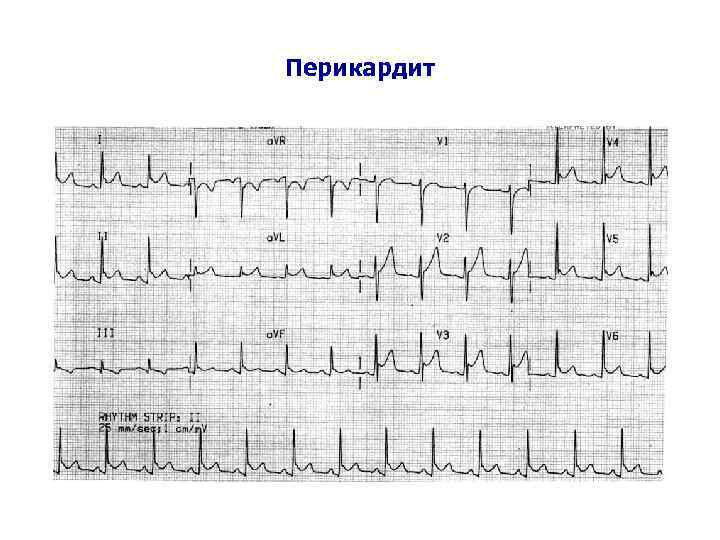Перикардит 