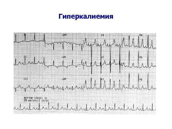 Гиперкалиемия 