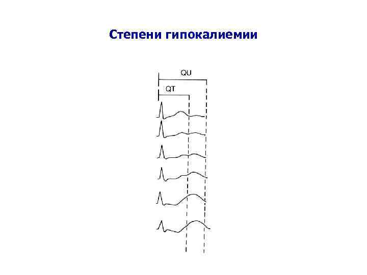 Степени гипокалиемии 