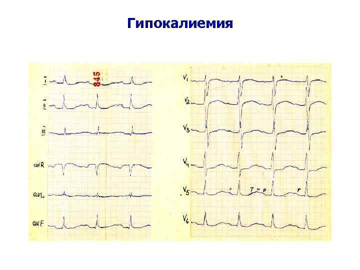 Гипокалиемия 