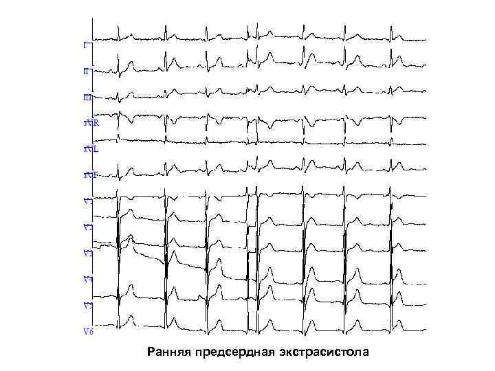 Ранняя предсердная экстрасистола 