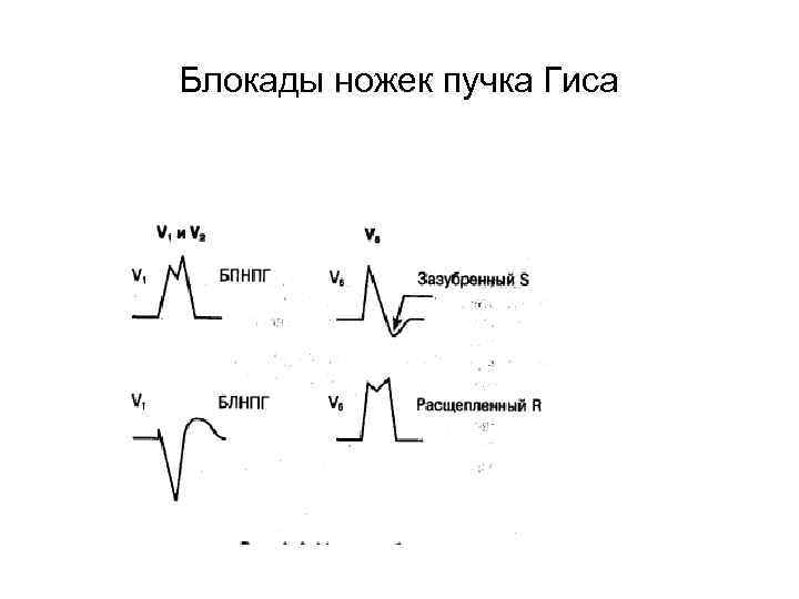 Блокады ножек пучка Гиса 