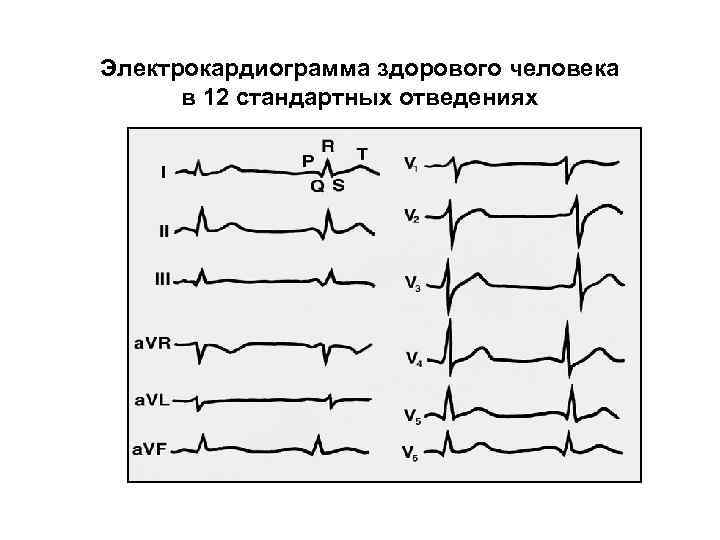 Электрокардиограмма здорового человека в 12 стандартных отведениях 