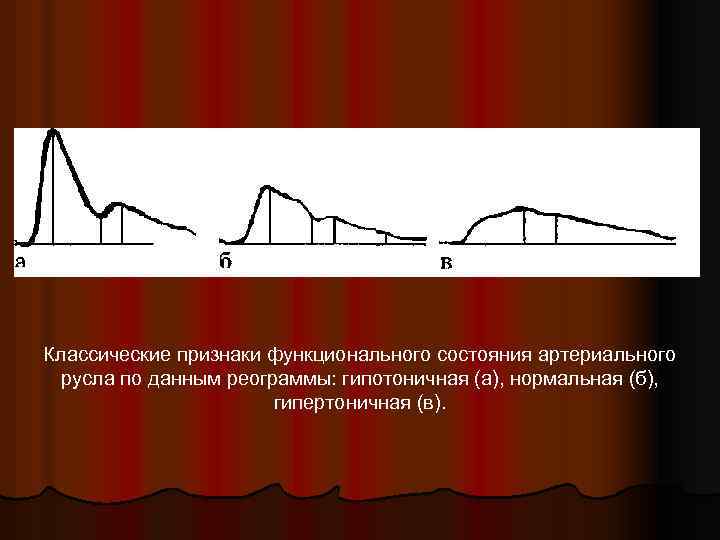 Классические признаки функционального состояния артериального русла по данным реограммы: гипотоничная (а), нормальная (б), гипертоничная