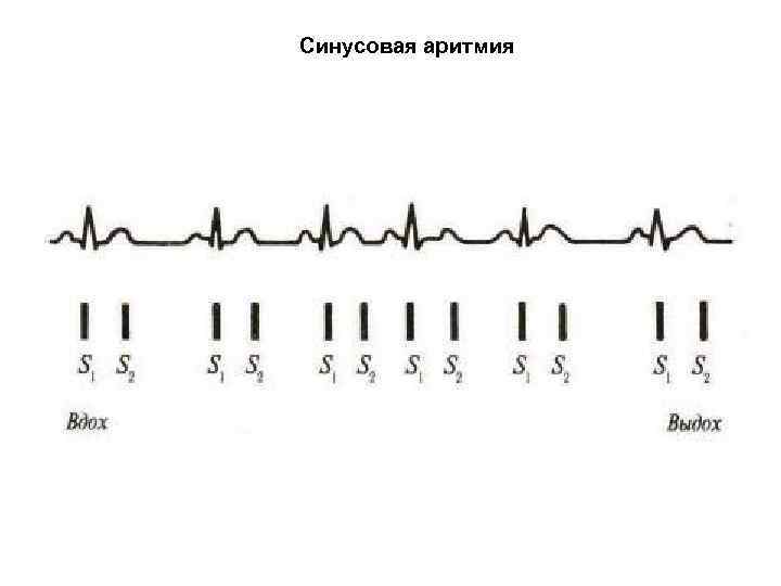 Синусовая аритмия 