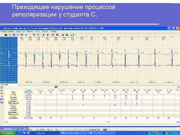 Преходящее нарушение процессов реполяризации у студента С. 